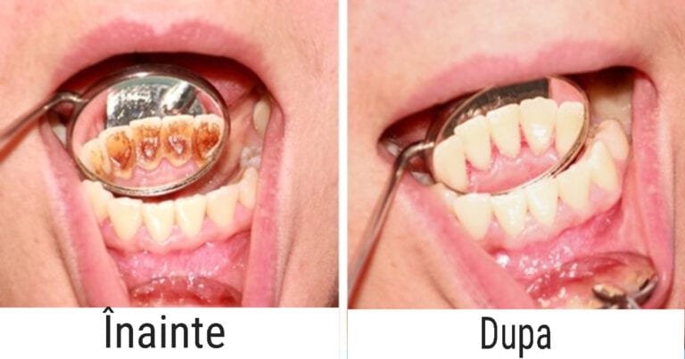 8 greșeli de îngrijire dentară pe care le facem cu toții